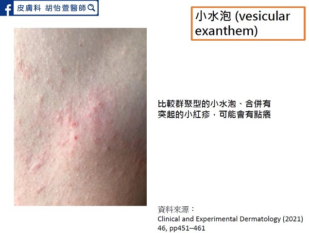 兒童確診紅疹