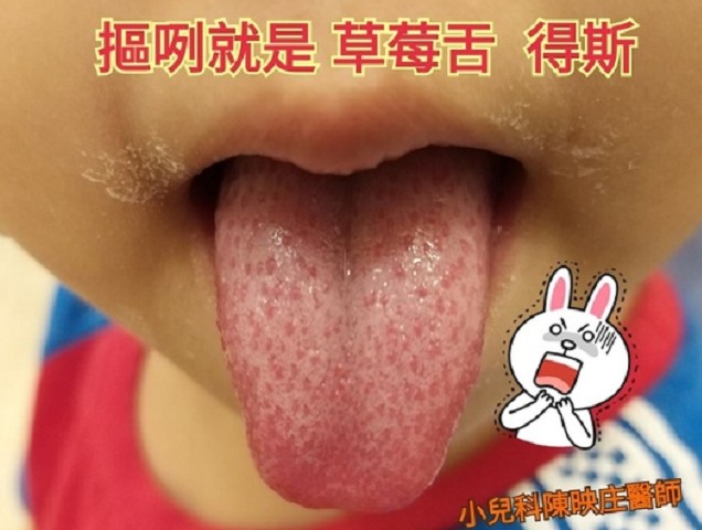 草莓舌