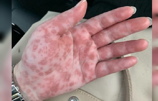 腸病毒初期症狀