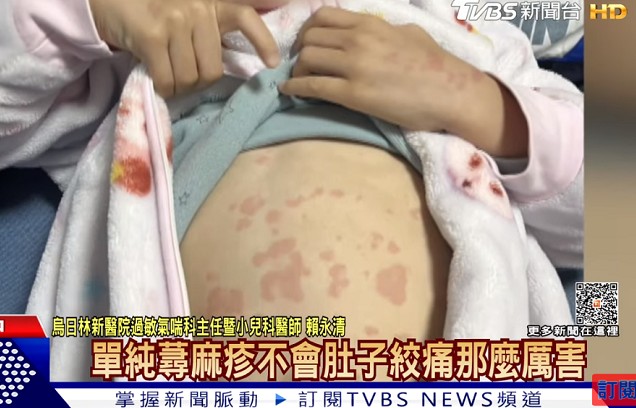 黴漿菌症狀