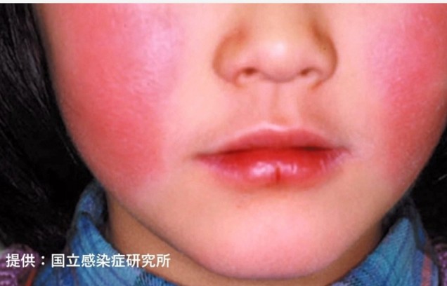 病毒疹照片