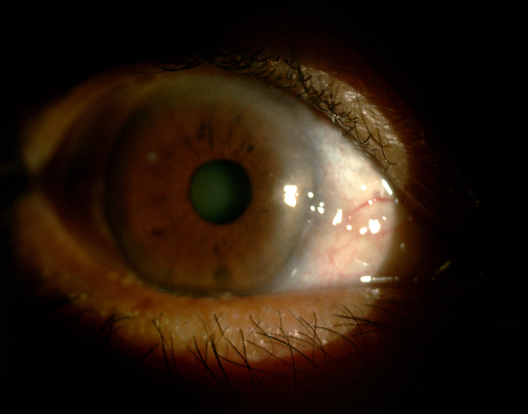 Superficial punctate keratitis seen in a patient with ocular rosacea