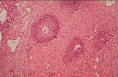 Basal cell hyperplasia (H & E 10 X)