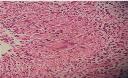 Granulomatous prostatitis (H &E 40 X)