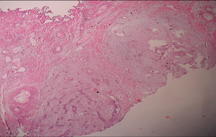 Stromalnodules (H & E 10 X)
