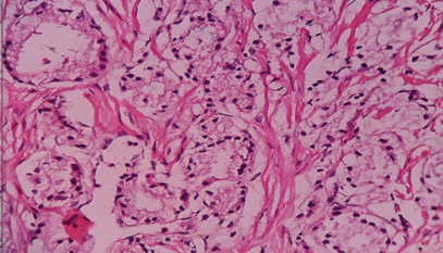 Prostatic adenocarcinomaGleasons pattern 3- close packed glands (H & E, 40 X)