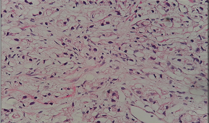 Prostatic adenocarcinoma Gleasons pattern 5 showing singly scattered tumor cells sheet (H & E, 40)