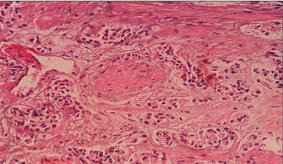 Prostatic adenocarcinomas showing perineural invasion (H & E 10X)