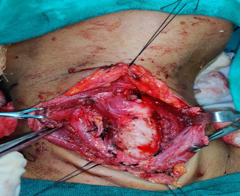 Branching pattern after hemithyroidectomy