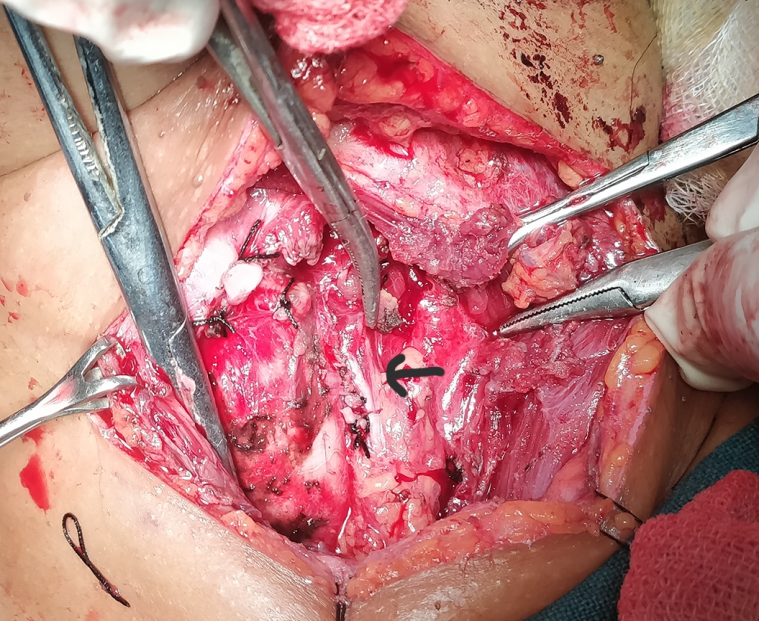 Duplication of left recurrent laryngeal nerve