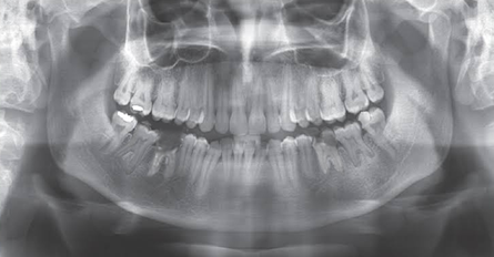 (Orthopantomogram)