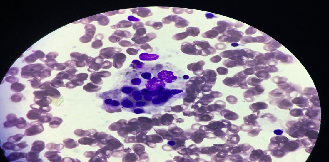 Macrophage showing hemophagocytosis in a case of Hemophagocytic syndrome.