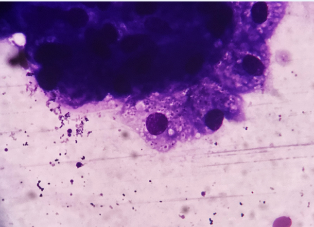 Smear from parotid gland aspirate showing acinar tisssue with a few scattered acute and chronic inflammatory cells along with numerous intracellular and extracellular small rounded organisms with a clear halo around them, morphologically consistent with Histoplasma capsulatum. (MGG stain, 400X)