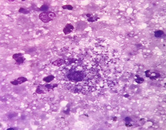 Punched out “holes” in the cytoplasm of a macrophage and in the background representing 3-5 micron yeasts of Histoplasma capsulatum (MGG stain, 1000X)