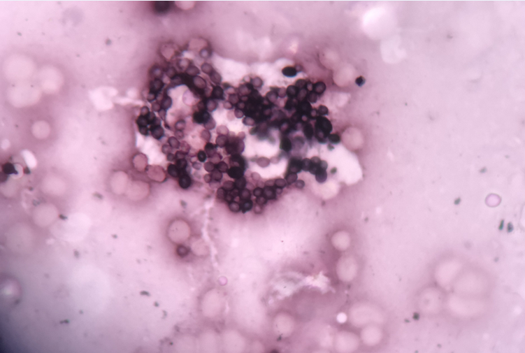 Histoplasma- Aggregates of black coloured oval yeast- forms having a thin capsule with narrow neck budding.(GMS stain, 1000X)