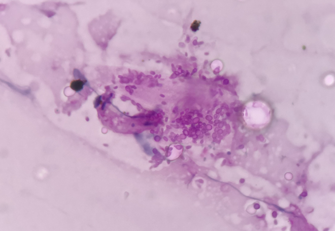 Histoplasma- Aggregates of pink coloured oval- yeast forms with narrow neck budding and thin capsule, in a macrophage (PAS stain, 1000X)