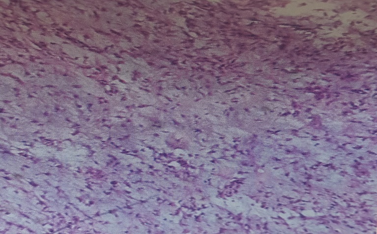Myxoid area in pleomorphic adenoma (Myxoid Differantation, H & E STAIN, 40 X)