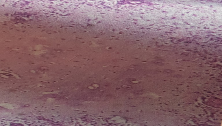 Chondroid differentiation in pleomorphic adenoma (CHONDROID DIFF, H & E STAIN, 40 X)
