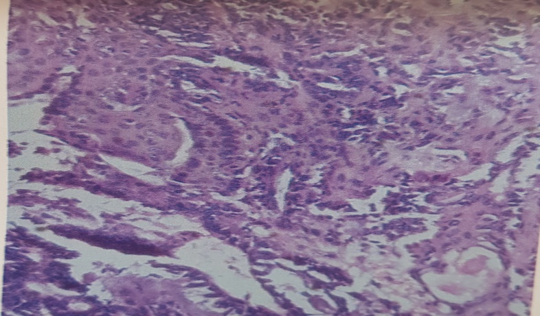Squamous differentiation in p leomorphic adenoma (SQUAMOUS DIFF, H & E STAIN, 40 X)