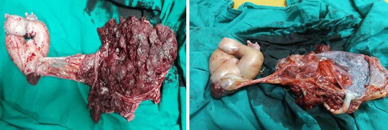 Acardiac acephalus twin with absent umbilical cord