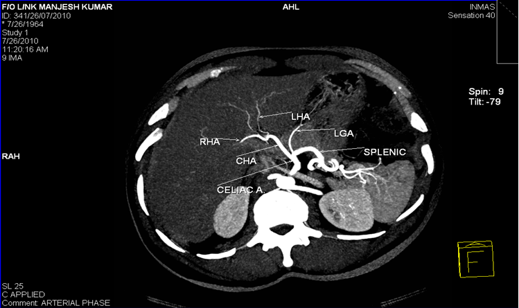 Normal hepatic arterial anatomy with right hepatic artery(RHA) and left hepatic artery (LHA) arising from common hepatic artery(CHA)