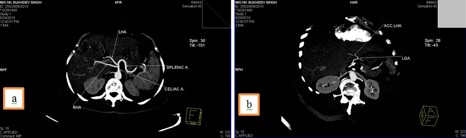 a: RHA and LHA from Celiac trunk, 2b: Accessory LHA from LGA
