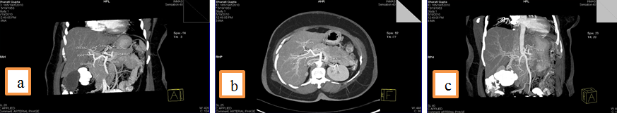 a: CHA from SMA, 3b: Accessory RHA from SMA, 3c: CHA arising from SMA and an accessory RHA from SMA.