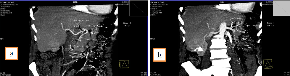 LHA arising from GDA and RHA from celiac trunk, 4b: Accessory LHA from LGA