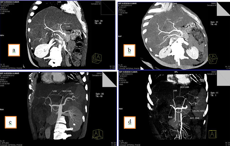 a: CHA from celiac trunk, 5b: Accessory RHA from celiac trunk, 5c: Accessory LHA from LGA, 5d: CHA from celiac trunk, accessory RHA from celiac trunk and accessory LHA from LGA.