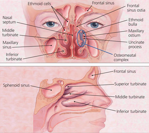 Osteomaetal complex with maxillary ostium under the middle turbinate
