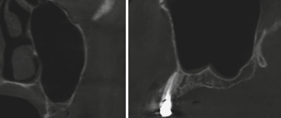 Schniederian membrane appearance in ct maxilla
