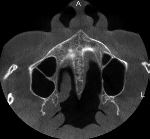 AXIAL CT image showingbony septa in maxillary sinus.
