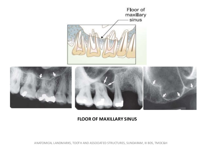 IOPA X-rays showing sinus floor