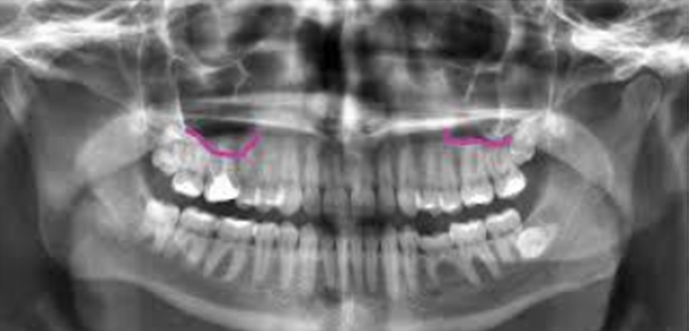 OPG X-RAY showing lower border of maxillary sinus bilateraaly