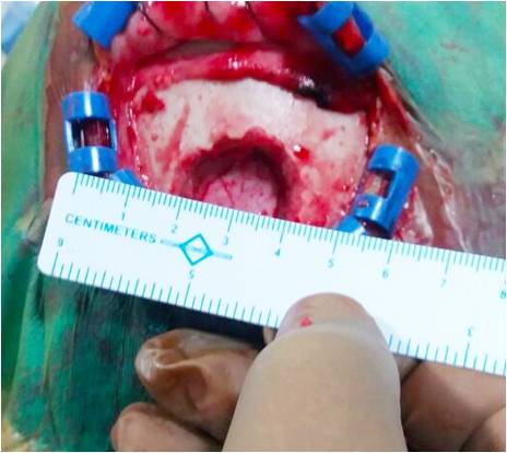 Burr hole was made 4cm lateral to midline and 3 cm anterior to the coronal suture