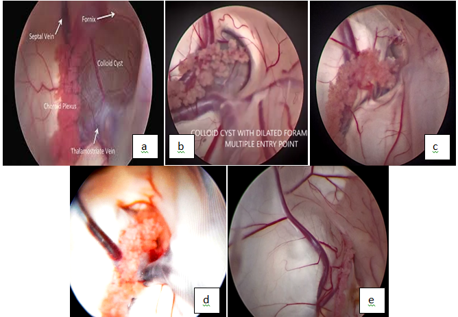 Foramen Monroe Endoscopic Anatomy with relation to the surrounding structure (a) large foramen monroe with related structure (b) large but difficult area of entry (c) coapted type with very small foramen with cyst bulging in the lateral ventricle (d) crescentric type foramen with choroid plexus covering the colloid cyst (e) displayed type in which foramen is totally closed and cyst is displayed into the lateral ventricle (f) image awaited