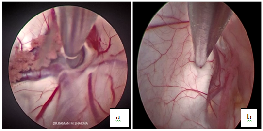 (a) : Transforaminal and (b): transseptal approach for excision of the colloid cyst