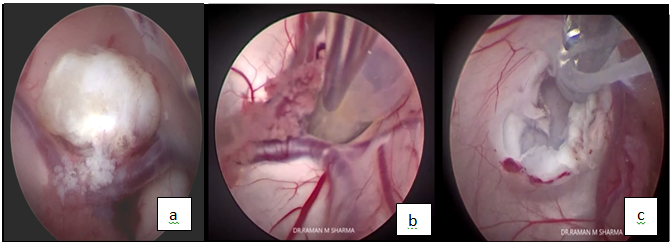 Type of the content (a): Calcified colloid cyst content removed with grasper and excising the cyst wall (b): Viscous content aspirated with suction tip (c): Thick content removed piecemeal with grasper and suction