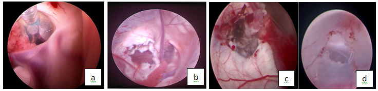 (a): Achieving hemostasis with tamponade by the fogarthy bulb inflation withinin the foramen monroe (b): Establishment of the Cerebrospinal fluid flow after excision of the coloid cyst after transseptal approach (c): Cauterization of both inner and outer surface of the cyst wall; (d): Third ventriculostomy at the end of procedure