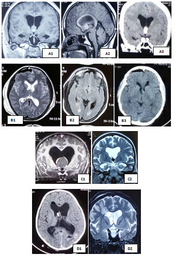 Preoperative and postoperative radiological evaluation (a) A-1 ,2 ,3 Foraminal type of colloid cyst with normal sized third ventricle B-1,2,3 Postoperative scan (b) Coapted and displayed type C1,2; and D1,2; are the postoperative scan of the corresponding patients