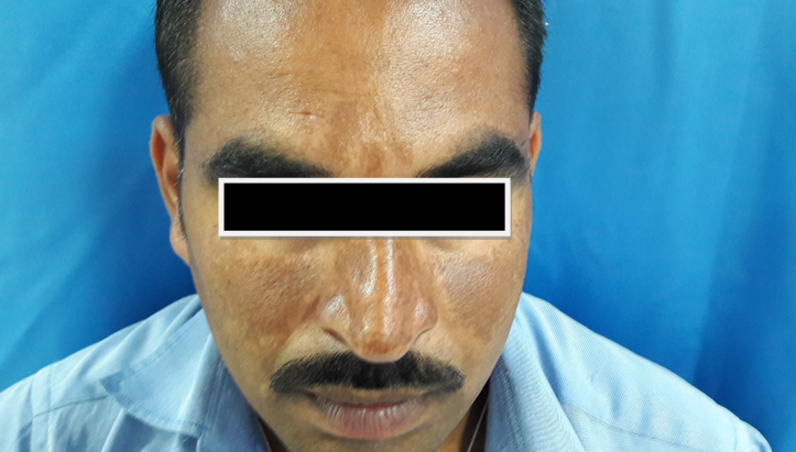 Centrofacial melasma in men