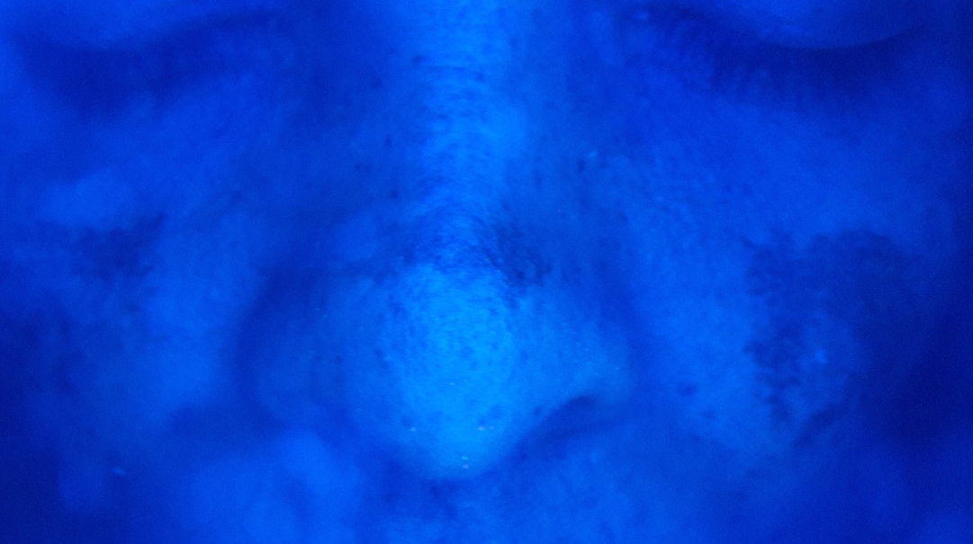 Patchy enhancement seen under Wood’s lamp