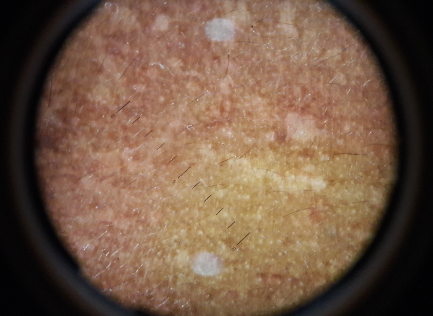 Reticuloglobular pattern under dermoscopy