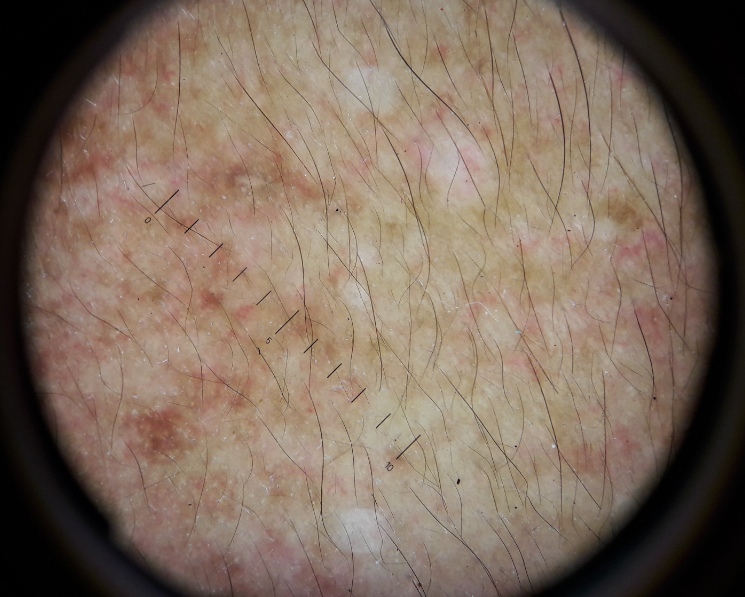 Telangiectasia observed underdermatoscopy