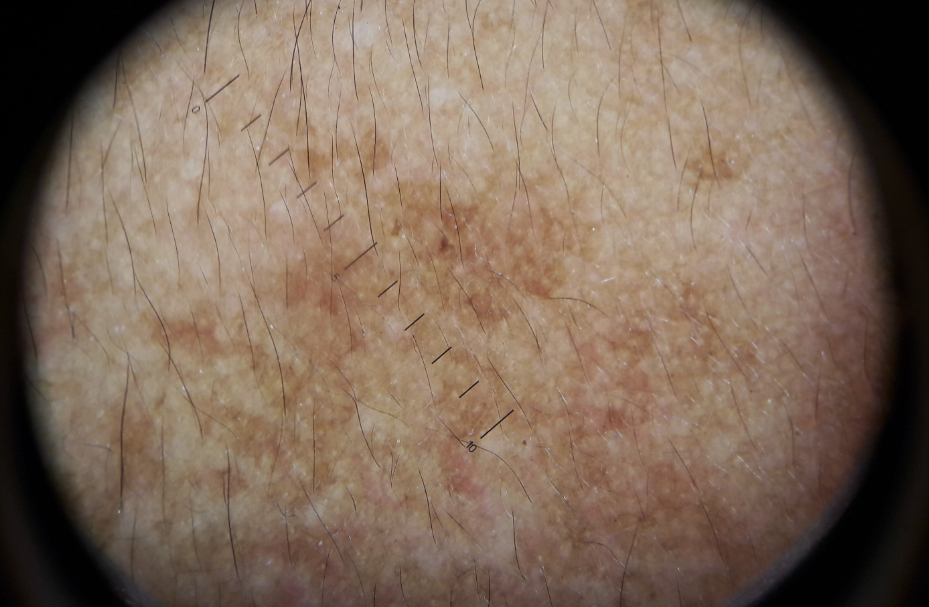 Epidermalmelasma under dermoscopy