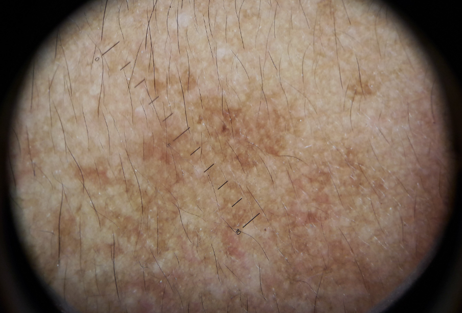 6: Epidermalmelasma under dermoscopy 2