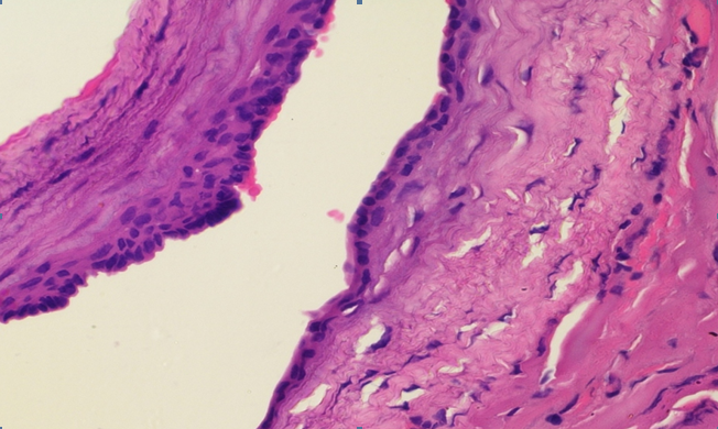 High power of Figure 1. Haematoxylin and Eosin x 40X.