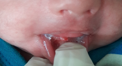 Photograph showing natal tooth with Inflamed mucosa around it
