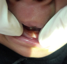 Photograph showing clinical appearance of a single natal tooth in primary mandibular central incisor region