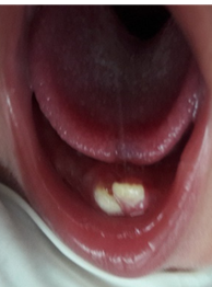 Photograph showing a pair of natal teeth in the mandibular primary incisor region